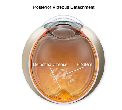 jelly in eye problem