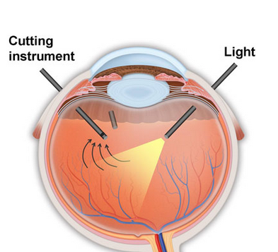 removal of jelly from eye